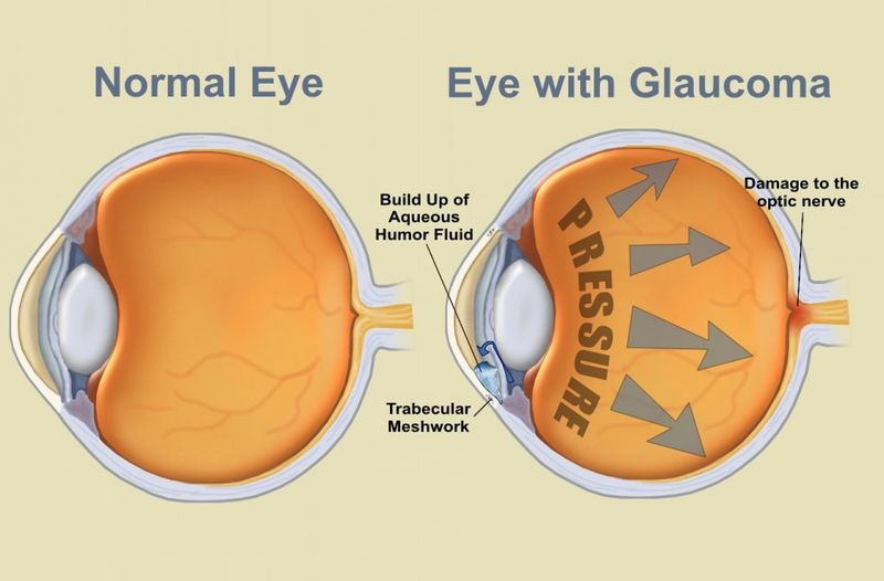 चित्र:Eyes-Glaucoma.jpg